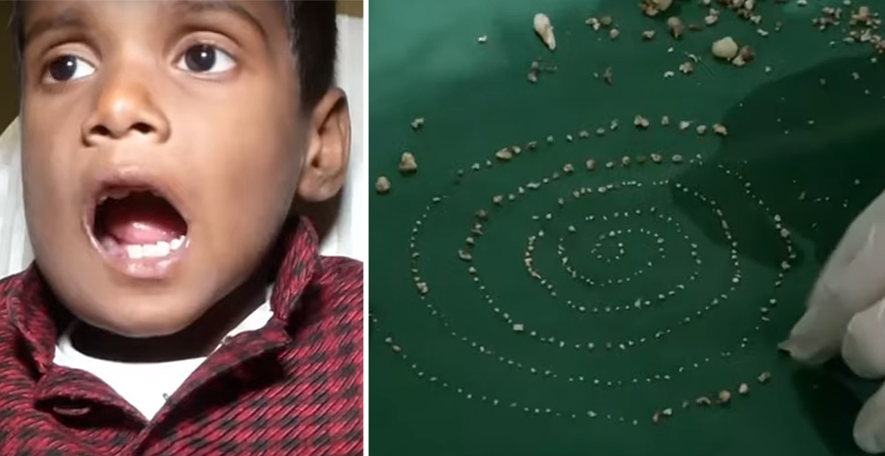 Boy Has 526 Teeth Removed