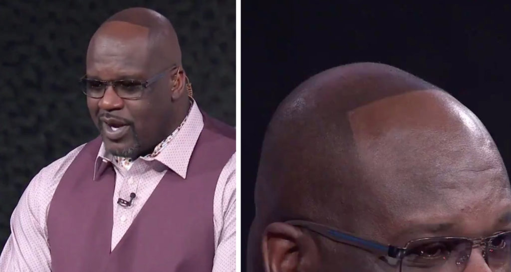 Shaq Grows Hair After Losing Bet